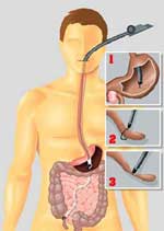 Cắt ruột thừa không cần mổ