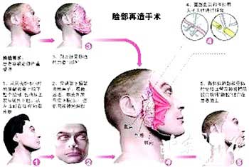 Kinh nghiệm cấy ghép mặt từ Trung Quốc