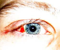 Bệnh của mắt