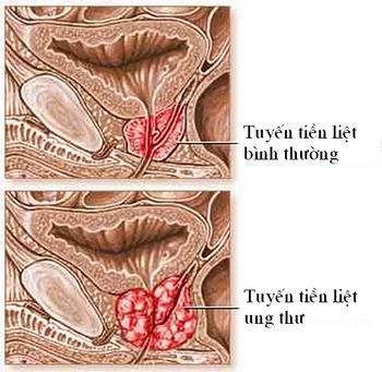 Dụng cụ mới chuẩn đoán ung thư tuyến tiền liệt