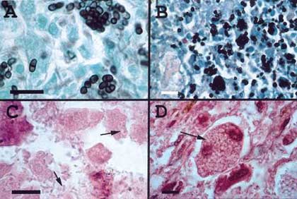 Nhiễm nấm Panicillium marneffei: Một chỉ điểm AIDS