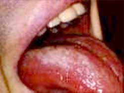 Nhiễm nấm Panicillium marneffei: Một chỉ điểm AIDS