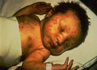 Thai phụ nhiễm Rubella có nguy cơ sinh quái thai