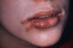 Các tổn thương mô mềm miệng ở trẻ em
