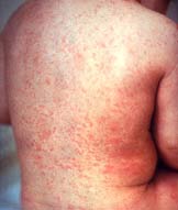 Môi trường thay đổi khiến dịch bệnh tăng
