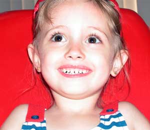 Mổ đẻ, tăng nguy cơ sâu răng ở trẻ