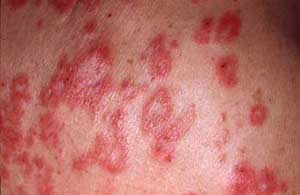 Bệnh lupus
