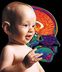 Nhiều trẻ sơ sinh viêm màng não