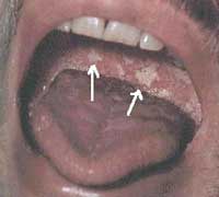 Các tổn thương mô miệng ở trẻ em