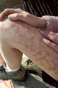 Thêm một căn bệnh khủng khiếp cho loài người