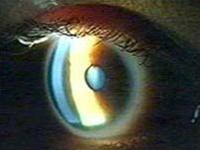Kiểm tra mắt có thể phát hiện bệnh Alzheimer