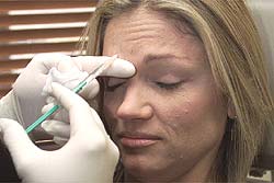 Botox, phương thuốc hiệu quả chữa lành vết thương không để lại sẹo