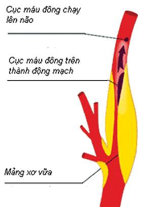 Hẹp động mạch cảnh - một trong những nguyên nhân gây tai biến mạch máu não