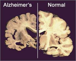 Tiếp xúc với từ trường cao làm tăng nguy cơ bệnh Alzheimer