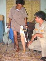 Chân giả bằng vật liệu mới: Nhẹ, dễ lắp và bền