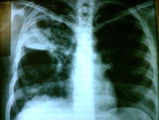 Lao phổi có di truyền?