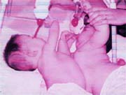 Hai bé dính nhau được tách rời đã bình thường