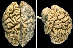 Não thiếu ôxy do đột quị có thể dẫn đến bệnh Alzheimer