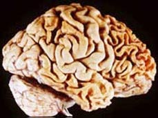 Tổn thương sọ não làm phát triển năng lực phi thường
