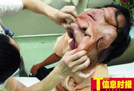 Trung Quốc: Phẫu thuật mặt cho “người voi”