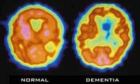 Scan não bộ có thể giúp chẩn đoán sớm bệnh Alzheimer