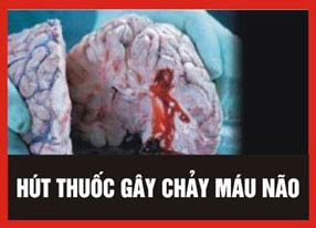 Năm hình ảnh cảnh báo phải in trên vỏ bao thuốc lá