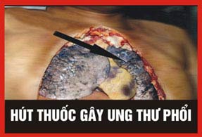 Năm hình ảnh cảnh báo phải in trên vỏ bao thuốc lá