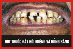 Năm hình ảnh cảnh báo phải in trên vỏ bao thuốc lá