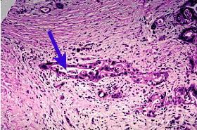 Tìm thấy tế bào gốc trong khối u ở tụy