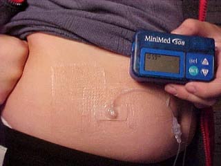 Thử nghiệm uống insulin để phòng ngừa bệnh tiểu đường típ 1