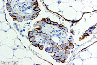 Phát hiện các kháng nguyên ung thư bằng các hốc nano