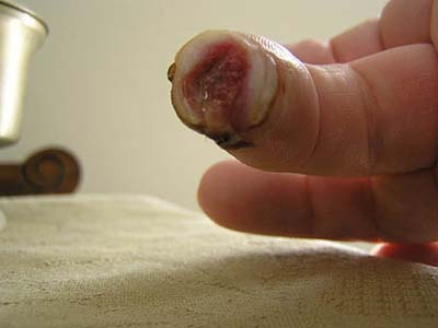 Làm được điều không thể: Mọc lại ngón tay bị cắt cụt