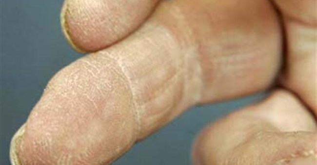 Làm được điều không thể: Mọc lại ngón tay bị cắt cụt