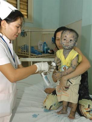 Coi chừng biến chứng từ bệnh thủy đậu