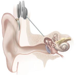 Điếc có thể làm tăng nguy cơ bị viêm màng não ở trẻ em