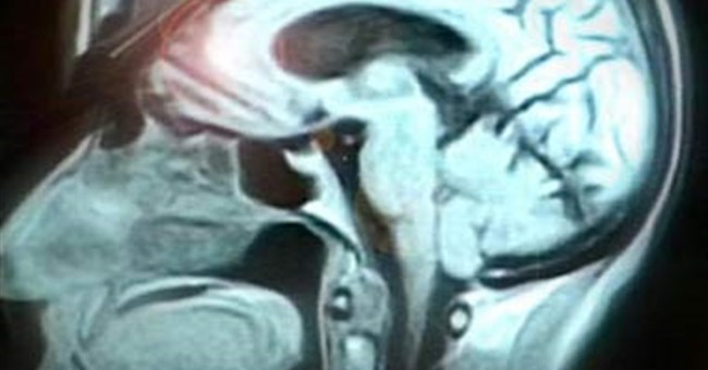 Não chú ý theo hai cách