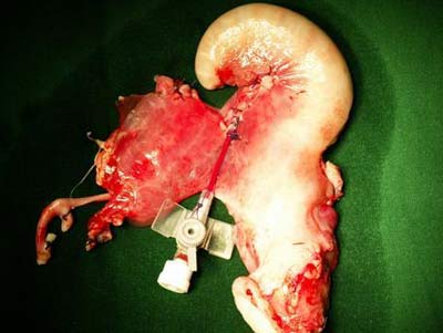 Mang thai sau khi cấy ghép tử cung