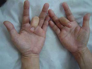 Hội chứng “ngón tay bật” là gì?