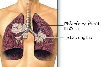 Nhu cầu thuốc chống ung thư tăng cao tại châu Á