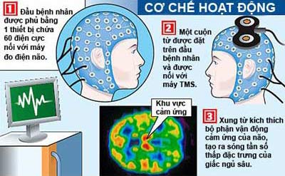 Trị mất ngủ: Không dùng thuốc, dùng sóng tác động vào não