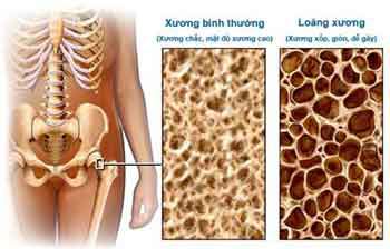 Chữa chứng loãng xương bằng truyền dịch