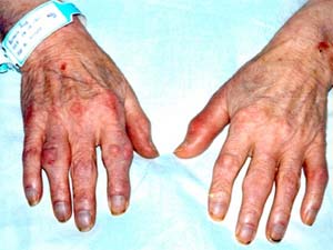 Bệnh thống phong: Uống cà phê, giảm nguy cơ mắc bệnh