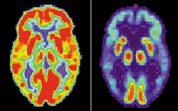 Phát hiện mới: Gien GAB2 liên quan đến bệnh Alzheimer