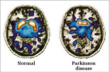 Thử nghiệm liệu pháp gien chữa bệnh Parkinson