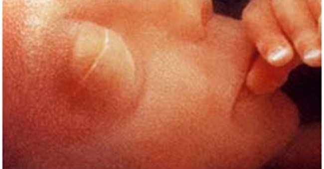 Tử cung nhân tạo