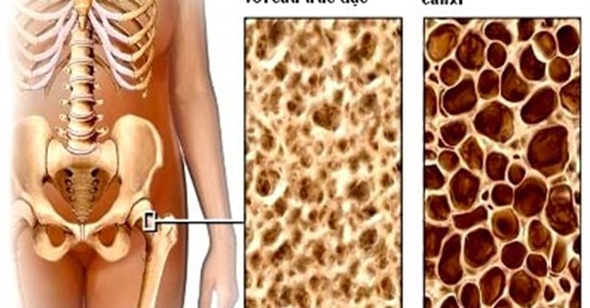 Loãng xương: 35 tuổi trở lên, phải đề phòng