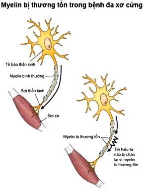 Phát hiện 2 gien gây bệnh đa xơ cứng