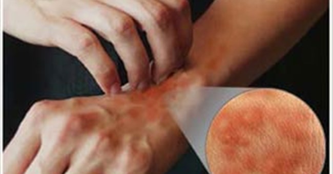 Phát hiện gen gây ngứa