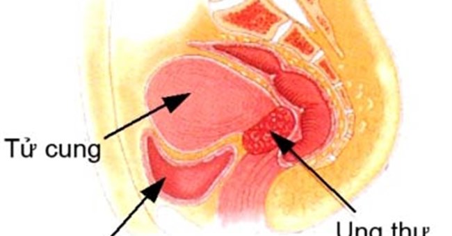 Giấm: Thuốc thử ung thư cổ tử cung