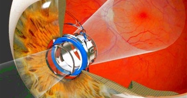 Kính viễn vọng siêu nhỏ giúp cải thiện thị lực